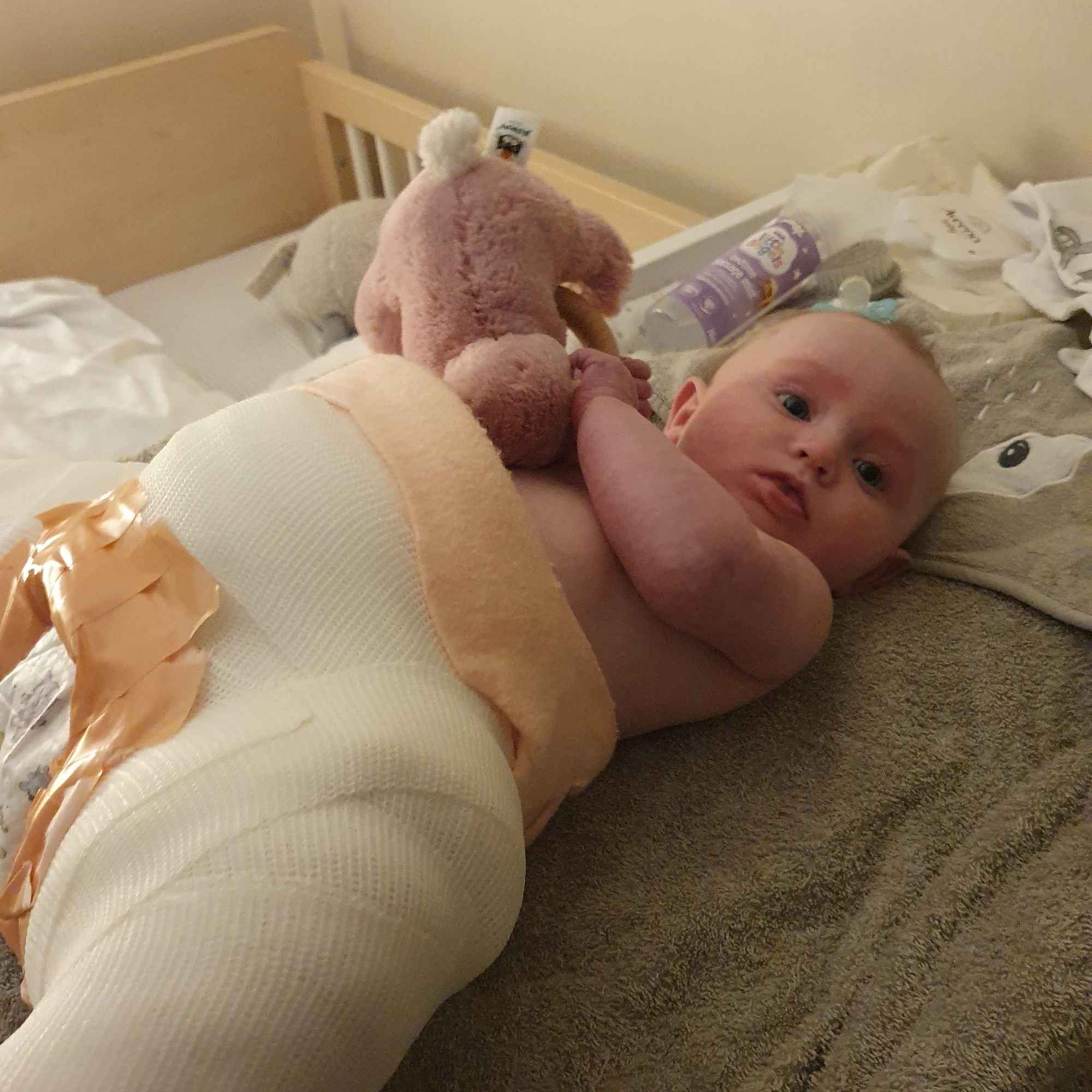Beautiful 4 month old baby lying on the bed in a hip spica cast playing with toy | Hip Dysplasia - Clair de Lune UK